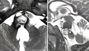 2 歲躺上開顱手術臺，3 歲又遭腦出血突襲：當我再度站在“鬼門關”前……