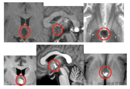 26歲青年高原返程后頭痛兩月未愈，一查竟是第三腦室“潛伏”的海綿狀血管瘤