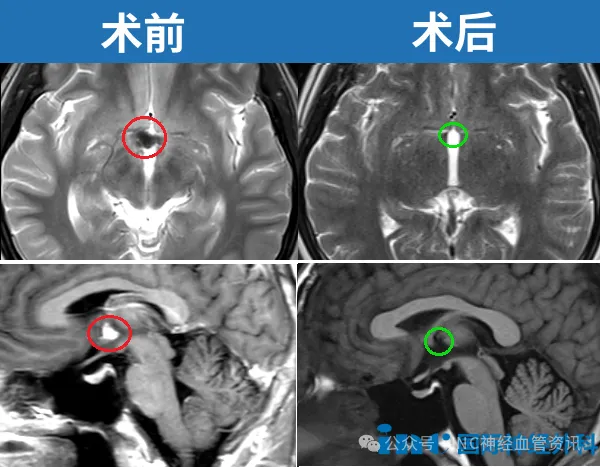 第三腦室病變，疑似海綿狀血管瘤