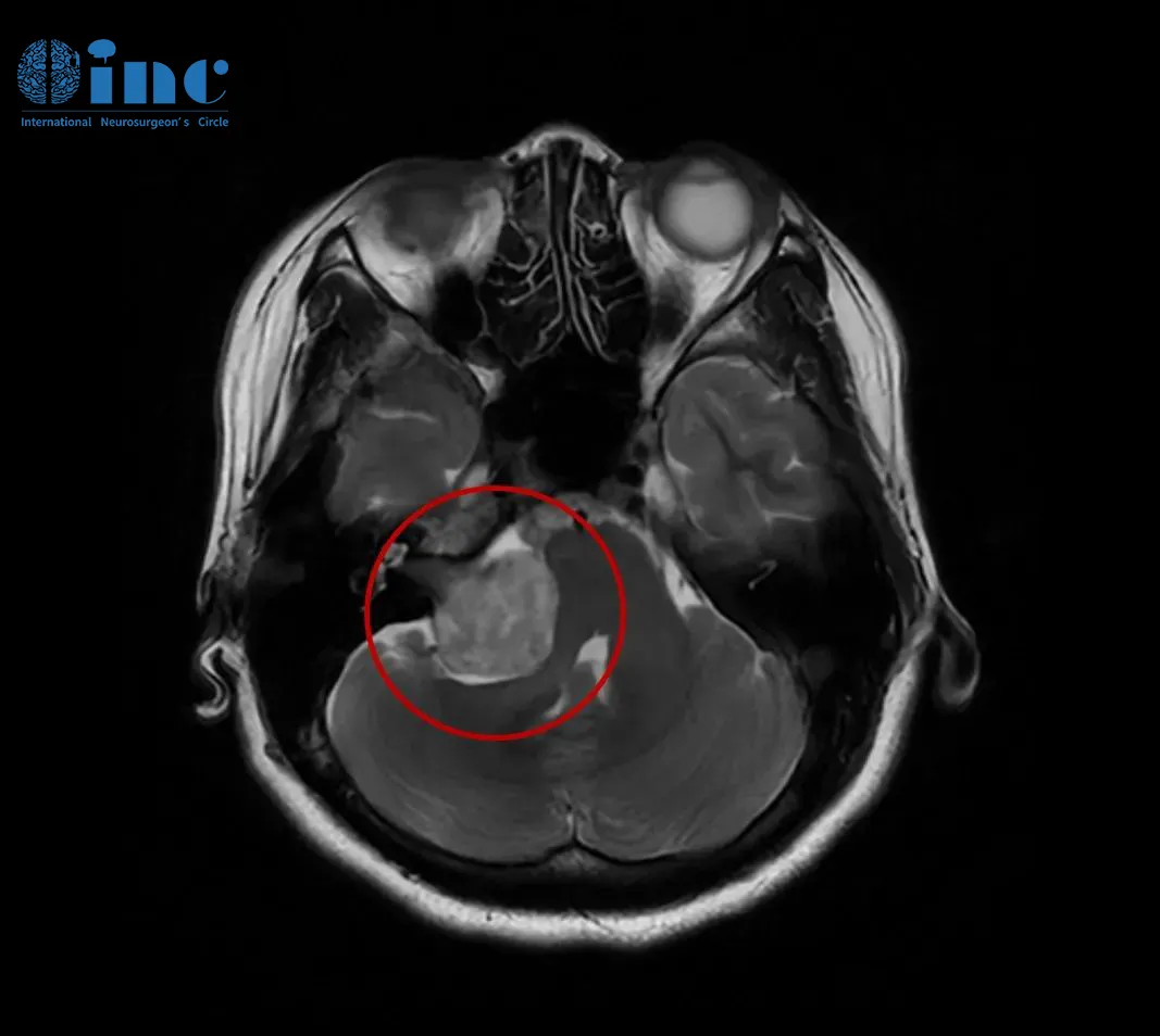 聽(tīng)神經(jīng)瘤（前庭神經(jīng)鞘瘤）影像