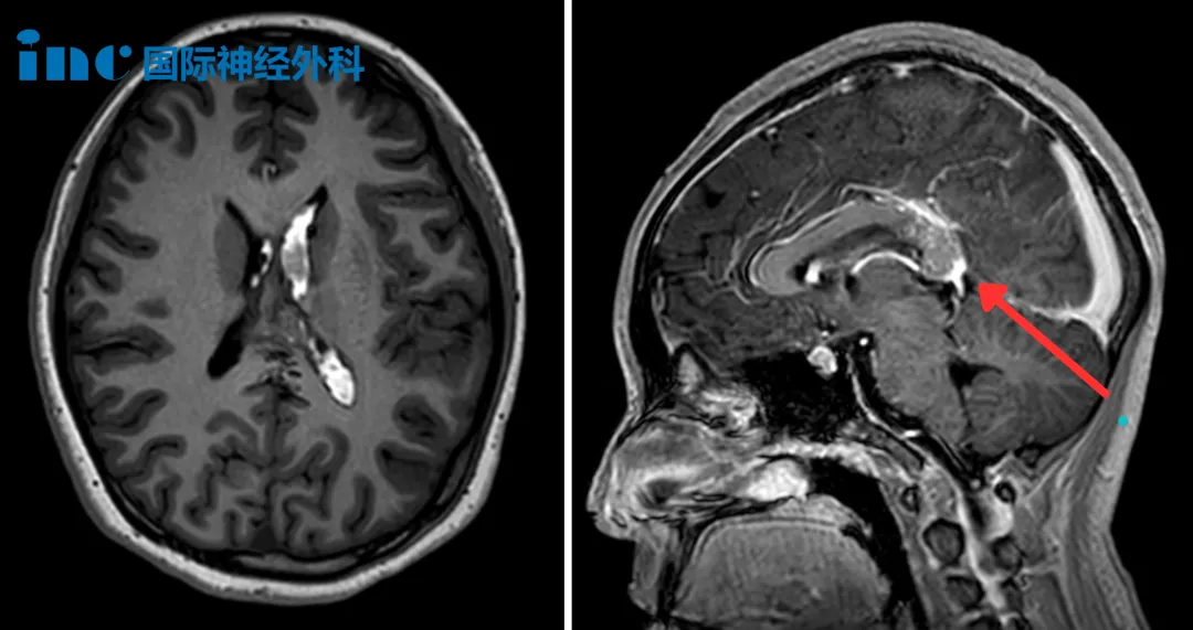 隨訪捷報！15歲高難度腦動靜脈畸形患者術(shù)后半年復(fù)查：“切除率100%，我認(rèn)為不會再復(fù)發(fā)！”