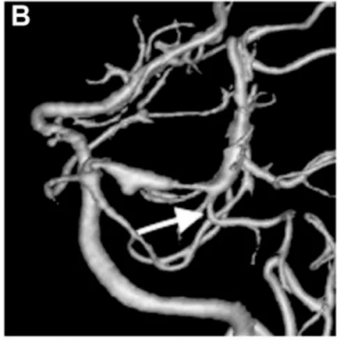 出血后18天血管造影顯示左側(cè)P1-P2段擴(kuò)張伴狹窄特征，顳后動脈自狹窄病變遠(yuǎn)端發(fā)出（箭頭標(biāo)注）