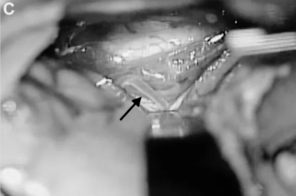 C、D.選擇顳后動脈（箭頭標(biāo)注）作為受體動脈，經(jīng)左側(cè)顳下入路用連續(xù)縫合行顳淺動脈-顳后動脈吻合；