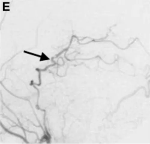 術(shù)后1周頸外動脈血管造影顯示，通過分流血管，整個左側(cè)大腦后動脈供血區(qū)血流良好（箭頭標(biāo)注）。