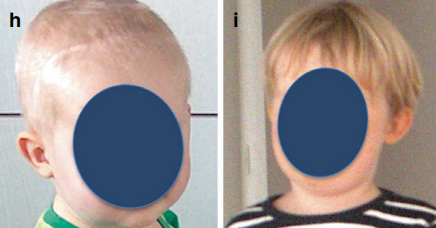 圖：術(shù)后1個(gè)月（圖H）及2年（圖I）復(fù)查顯示，患兒臨床狀態(tài)優(yōu)良。