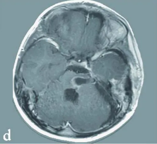 3歲娃突發(fā)偏癱嗜睡，小小頭顱內竟暗藏巨大橋腦海綿狀血管瘤危機！