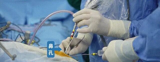 2次經(jīng)鼻內(nèi)鏡無法全切，開顱又傷重要血管，這個良性腦瘤為何讓她屢陷險境？