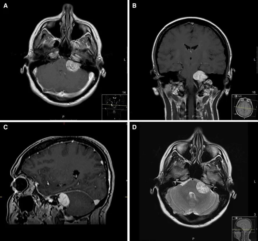 夜間頭痛總痛醒？40歲女白領(lǐng)頭痛史背后，竟查出聽神經(jīng)瘤！
