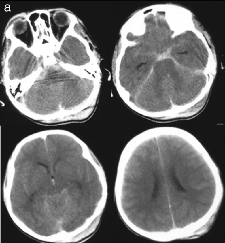 一場車禍，兩重劫難：8歲男孩闖過急救關(guān)后又因顱內(nèi)創(chuàng)傷性動脈瘤命懸一線！